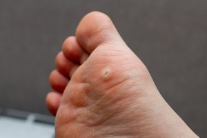 Wart Removal Toronto Wart Removal Toronto