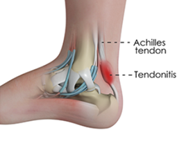 Achilles Tendonitis Toronto