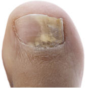 Toenail Fungus Toronto