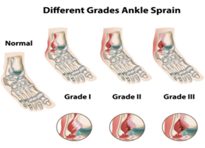 Ankle Sprain Toronto