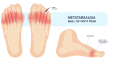 Metatarsalgia Toronto