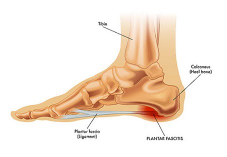 Plantar Fasciitis Toronto