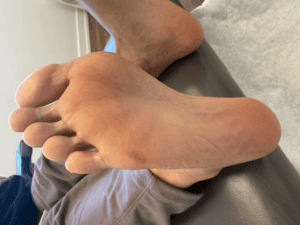 After Wart Removal Surgery Toronto