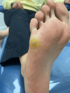 Before Wart Removal Surgery Toronto